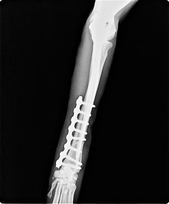 radial fracture repair with locking sop plate