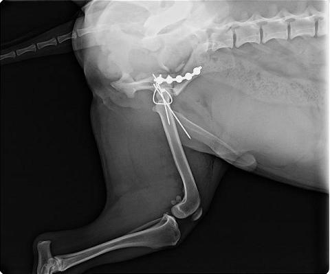 acetbular pelvic fracture repair with new sop plate