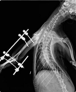 supracondylar humeral fracture