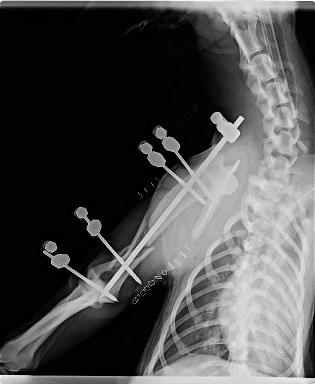 post op with sks external fixator